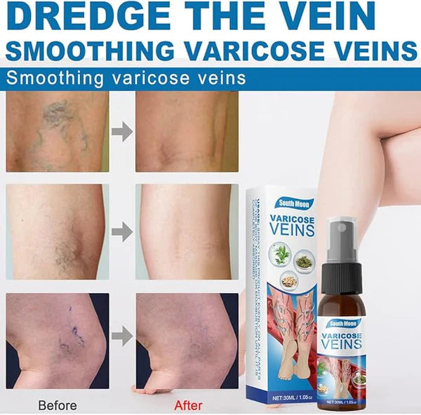 Last Day Of Discount 🔥 Varicose Veins Spray