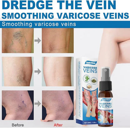 Last Day Of Discount 🔥 Varicose Veins Spray