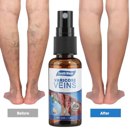 Last Day Of Discount 🔥 Varicose Veins Spray