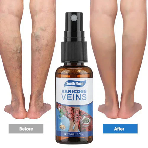 Last Day Of Discount 🔥 Varicose Veins Spray