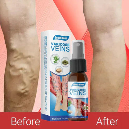 Last Day Of Discount 🔥 Varicose Veins Spray